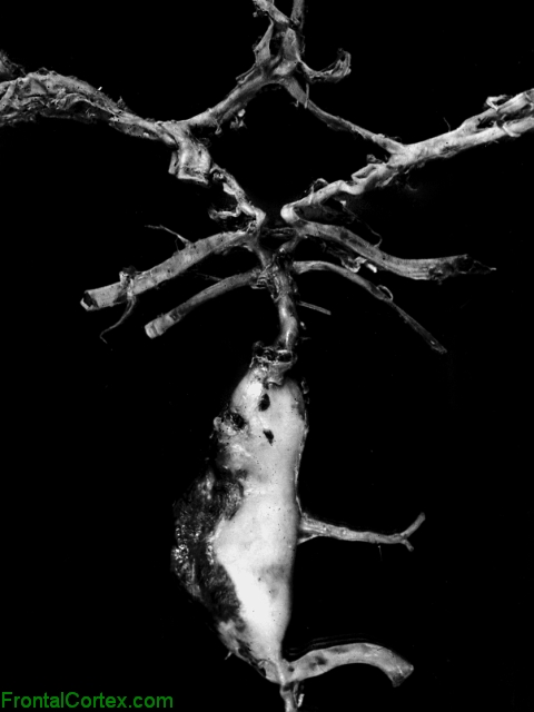 Fusiformvertebro-basilar aneurysm, dissected circle of Willis.